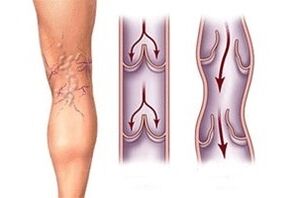 odpływ krwi w żylakach na różnych etapach rozwoju choroby